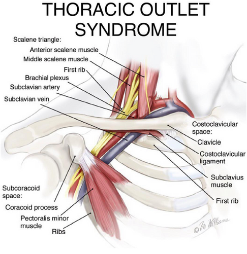 Thoracic outlet syndrome TOS. Sovende fingre, nedsat kraft, nedsat styrke, prikker i hånden. Vi er eksperter i behandling af TOS. Osteopati København og Ballerup